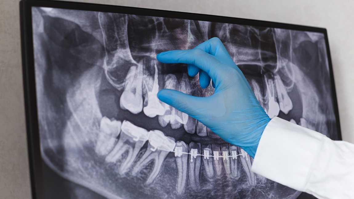 How to Prevent Dental Caries